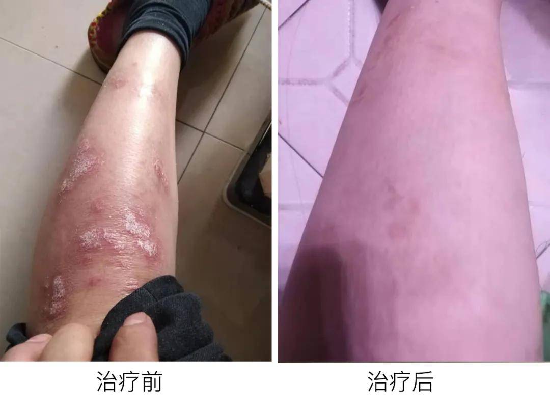 陈碧琴医师半年治好牛皮癣守得云开见月明