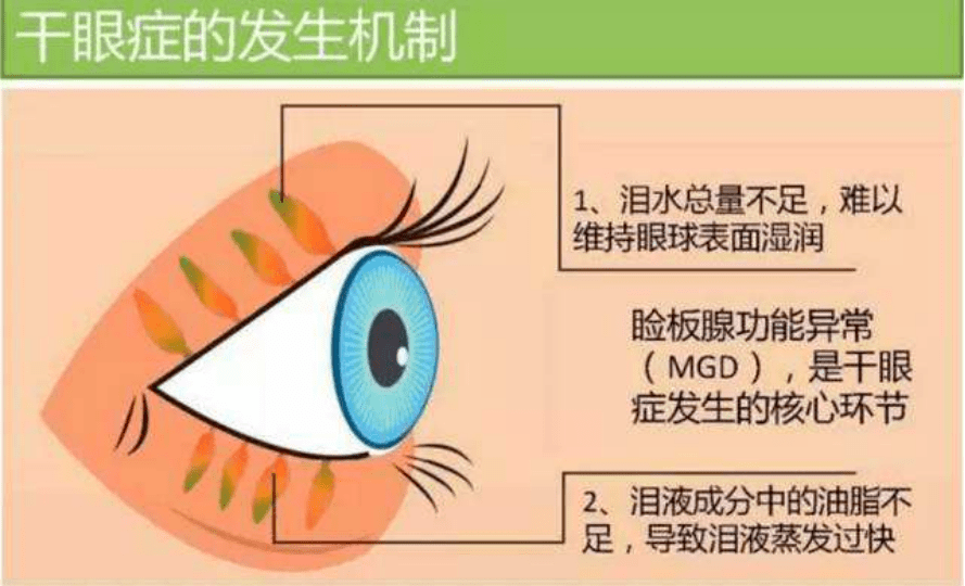 干眼症的多数症状与视疲劳相似,主要表现为 眼干涩不适,视物模糊,眼红