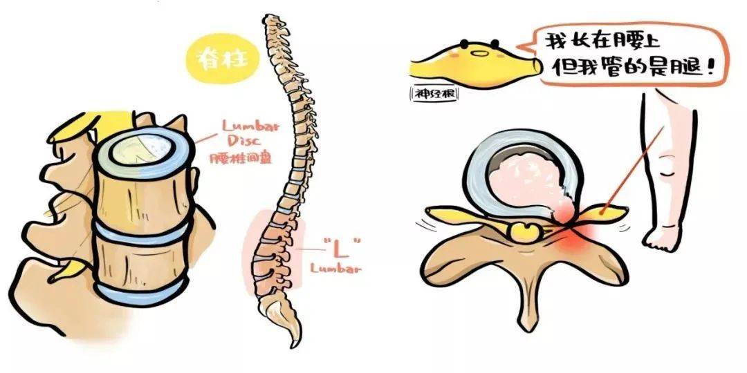 腰椎间盘突出后压迫到坐骨神经就会引起腿疼.