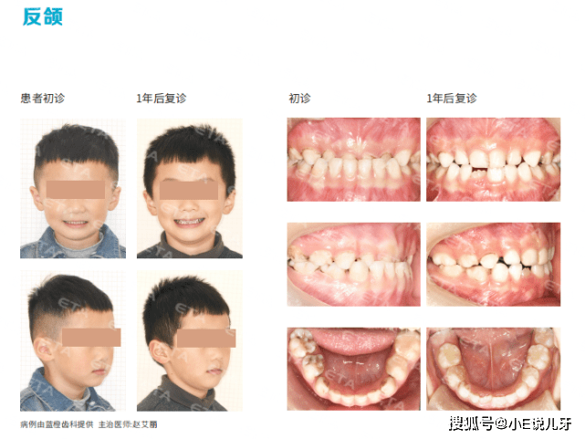 eta矫正器可以改善脸型吗
