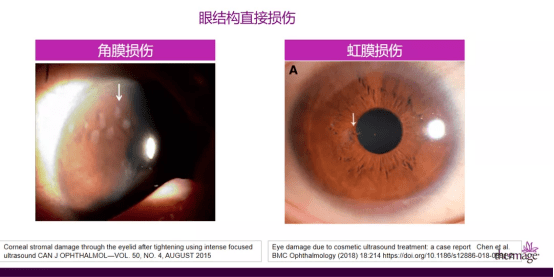 热玛吉眼部专项抗衰第三期丨眼部治疗的有效性与安全性