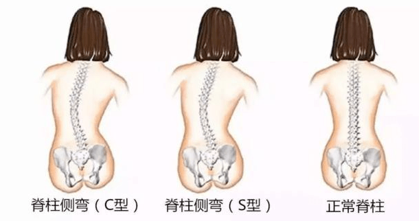 (4)两侧腰部不对称,一侧(凹侧)腰部出现皮纹褶皱.