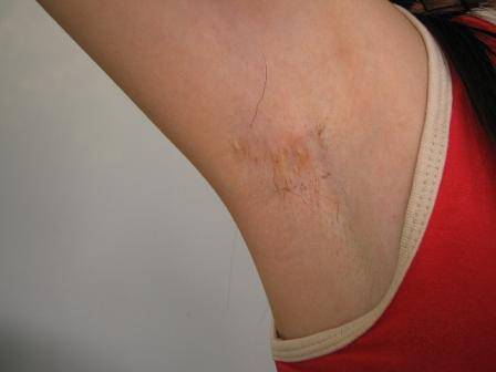 腋下手术疤痕能祛除吗?用哪种方法效果好?