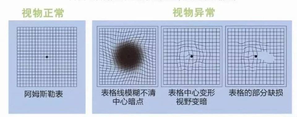 一张图自测黄斑变性