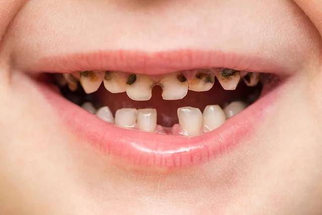 5岁孩子竟有16颗蛀牙,久拖不治,得了牙髓炎