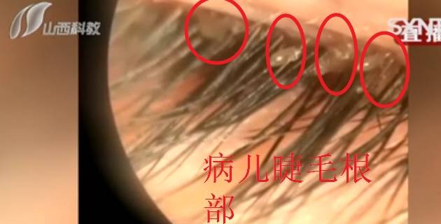 医生从女童眼部取出20只活虫,父母的做法太反面,大部分人都在犯