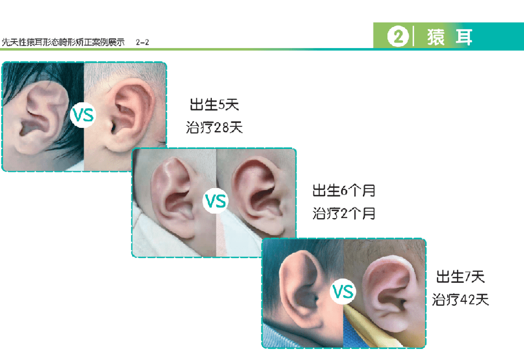 随着科技的发展,耳廓畸形的宝宝们在新生儿期就可以通过佩戴矫形器,对