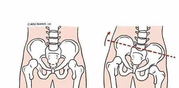 关于骨盆侧倾,一定要早发现早矫正,自我检测走一波!