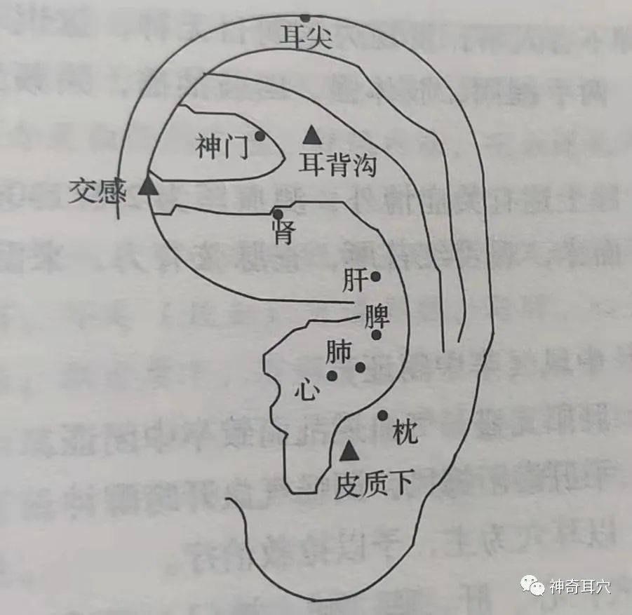 【治疗】取耳穴:心,肝,脾,肺,肾,枕,神门,交感,皮质下,耳背沟,耳尖