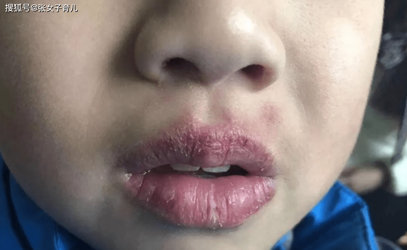 宝宝嘴唇干裂多喝水也没用怎么办看看老中医的正确护理方法