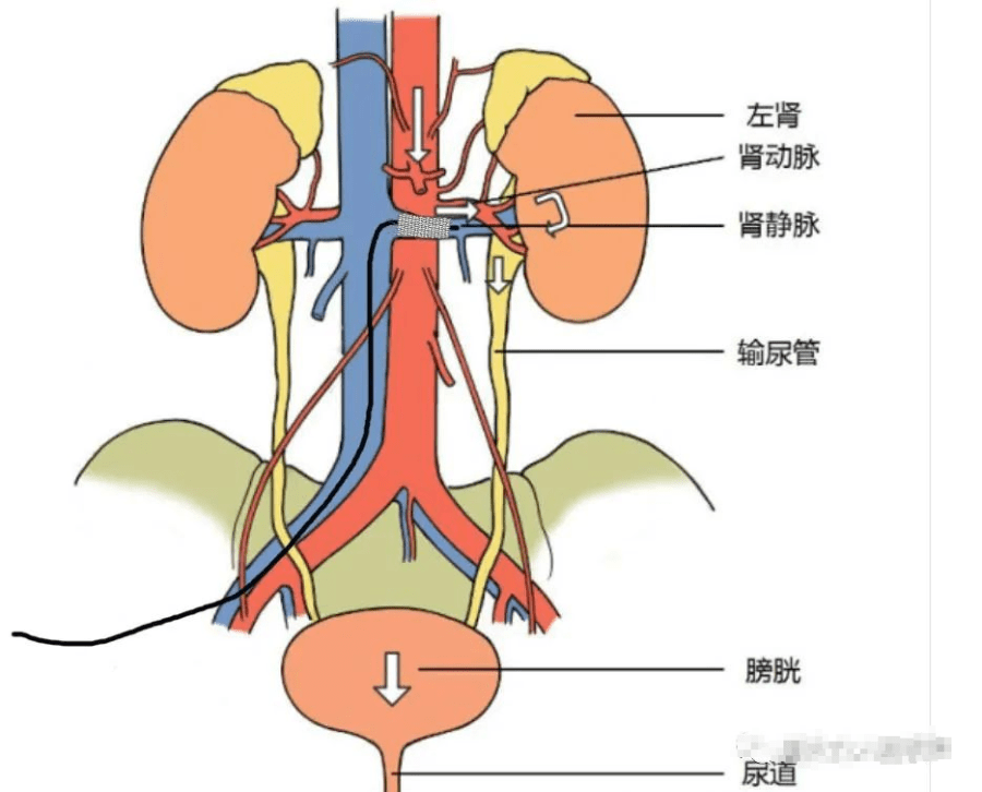 胡桃夹综合征的介入治疗_静脉