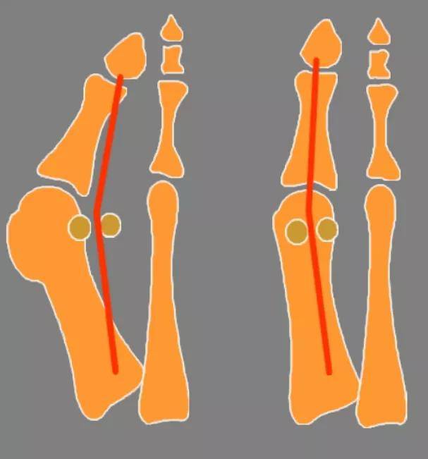 拇外翻畸形与足部生物力学失衡间的关系_横弓_河南_安阳