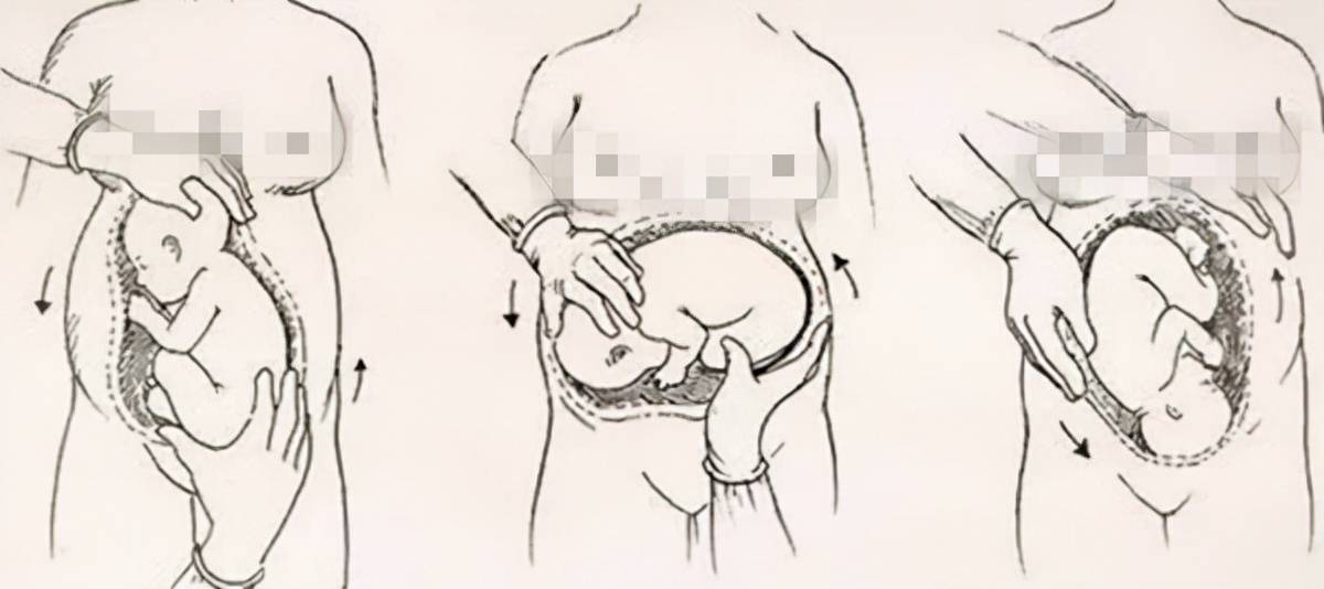 孕期胎儿臀位,怎么才能避免剖腹产？现实版＂乾坤大挪移＂了解下