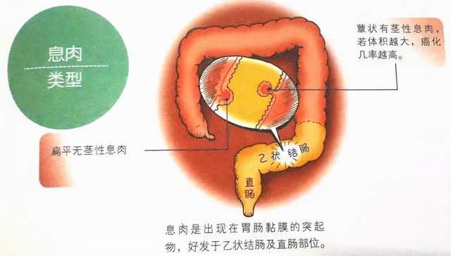 警惕导致肠息肉的四大常见原因