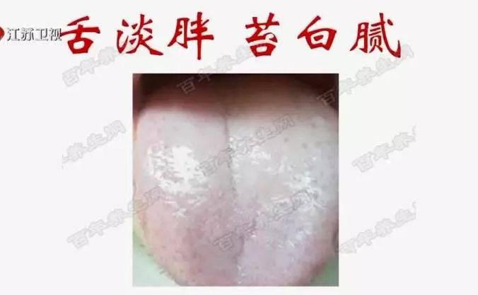 看舌头,知全身!_舌苔_裂纹_边有齿