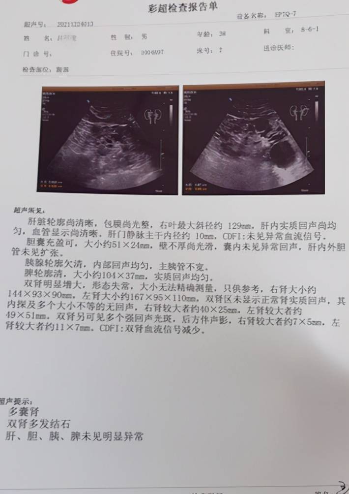 原创多囊肾到底严重吗发现囊肿8年多终于控制住了