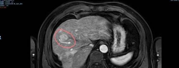 原创体检发现小结节再检竟然是肝癌结节有这样的表现一定要警惕