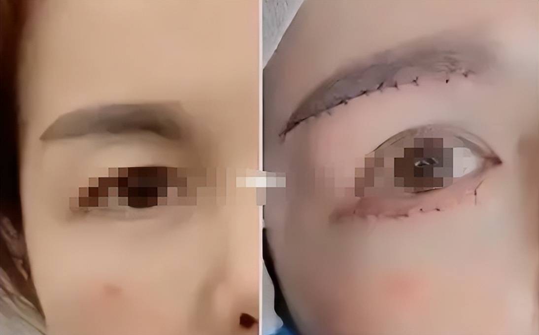 提眉眼袋手术后怎样恢复得快?亲测案列!_皮肤_伤口_因子