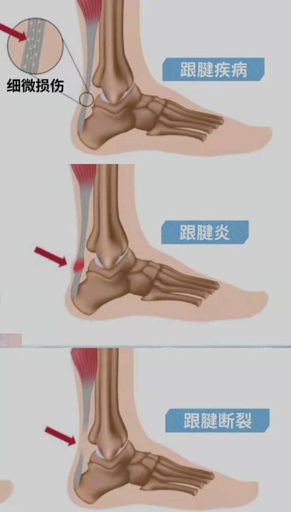 脚后跟发出嘣的一声后就再也跳不起来了