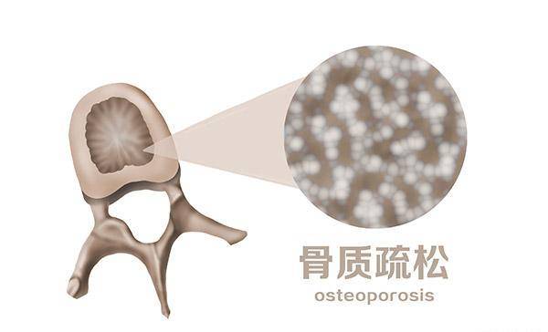 骨密度低到几要补钙？预防骨量松散，除了补钙还要怎么做？