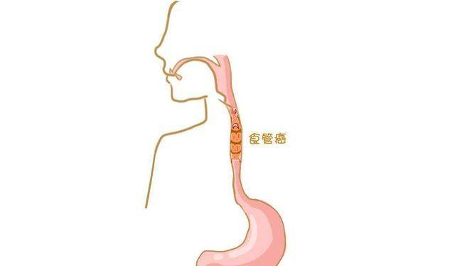 吞咽困难的常见原因有哪些？教你如何排除食管病