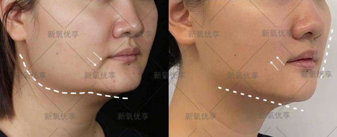 层提升，下垂问题得到改善，因下垂而产生的法令纹、嘴角阴影自然消失。