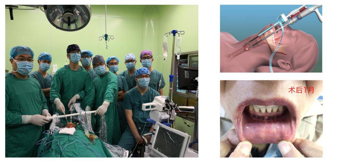 2018年9月,完成首例经口腔镜甲状腺手术.