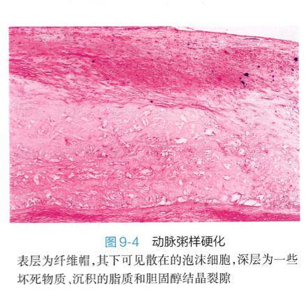 ⑥面包和奶油心包炎(bread and butter pericarditis)