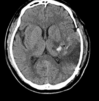 死地只有一招可以破解！脑组织被挤变形？这种快速置人于死地的危重状态