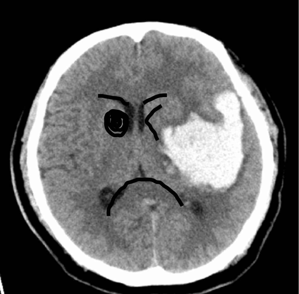 死地只有一招可以破解！脑组织被挤变形？这种快速置人于死地的危重状态