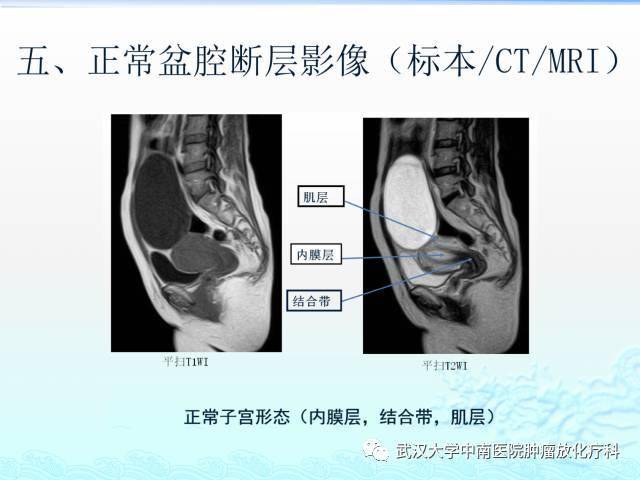 女性盆腔解剖与断层影像