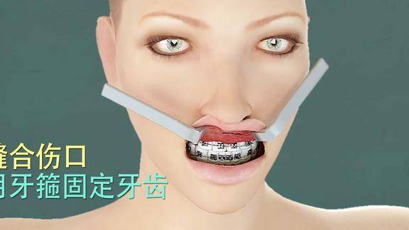 牙齿痛系列3d演示:骨性龅牙整形手术过程,要变美还是要丑