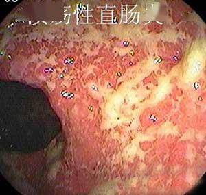 25岁男性便血,疼痛,腹泻,体重下降,不是直肠癌,原因出乎意料