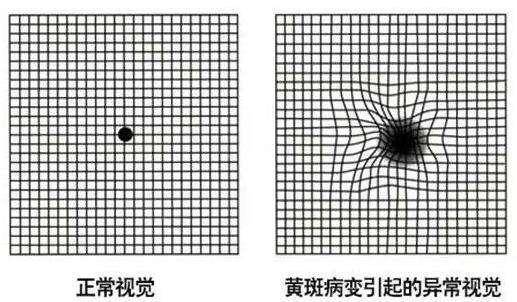 什么是黄斑病变图片 8c0f337151d3472a80471c00acd4c18c.jpeg