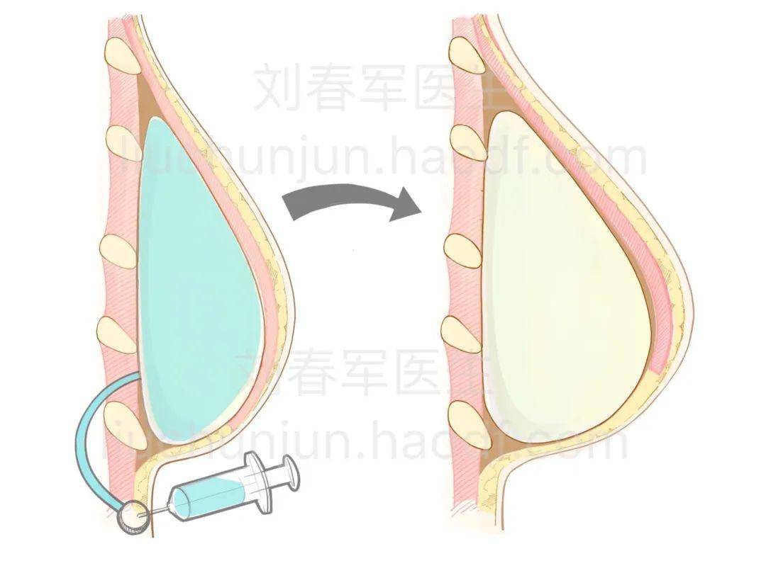 乳腺癌切除术后,如何再造一个有血有肉的乳房?