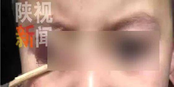 揪心!4岁女童右眼被竹签戳伤,两天都睁不开眼……四类伤眼事件要警惕
