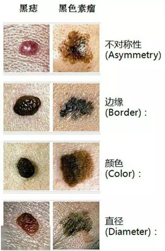 具体如下: 1,对称性 观察色素痣的表面,我们会发现,良性色素痣两边是