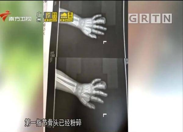 「健身」导致手指截肢！很多小区都有……，当心！4岁男童被这种器械夹伤