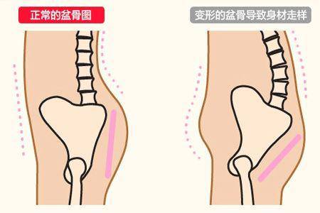 臀部又扁又下垂不好看是盆骨出了问题一个小妙招轻松矫正