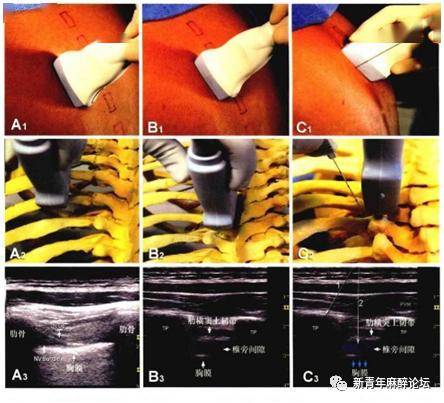 超声引导下椎旁神经阻滞的经典入路有短轴平面内,长轴平面内及长轴