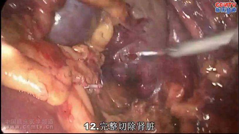 手术演示丨解剖性后腹腔镜根治性右肾切除术