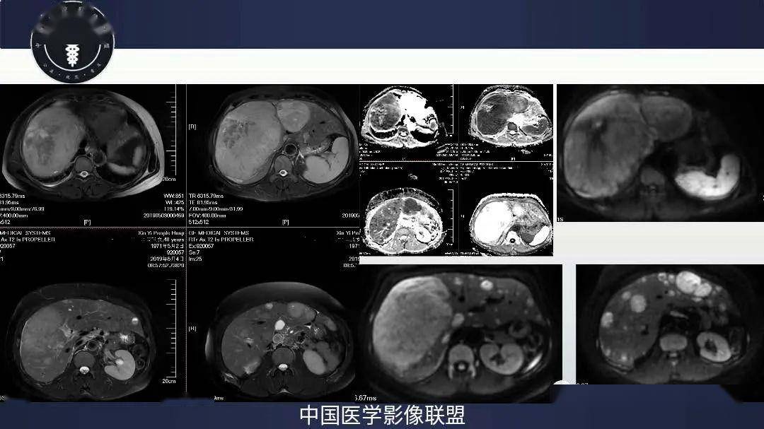 增强后病灶轻中度延迟强化,nse高,肝脏神经内分泌肿瘤g3伴肝内转移