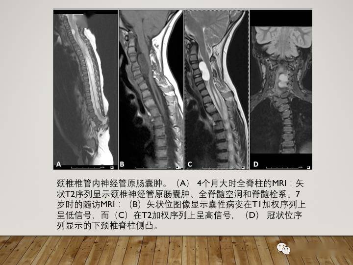 影像病例学习:神经管原肠囊肿