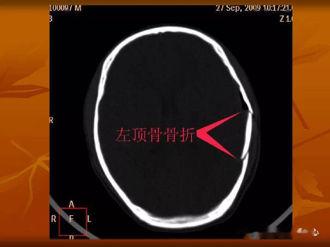 颅骨外伤性骨折ct诊断