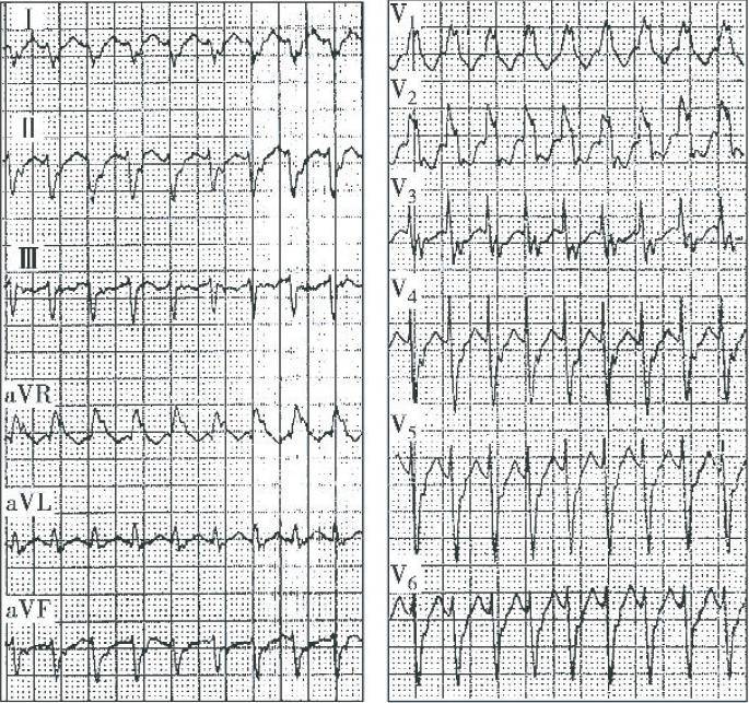 时期发作心悸时记录心电图均呈右束支传导阻滞(rbbb)型宽qrs波心动过