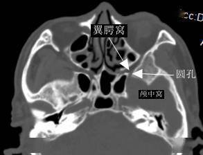 一文搞懂复杂解剖:翼腭窝