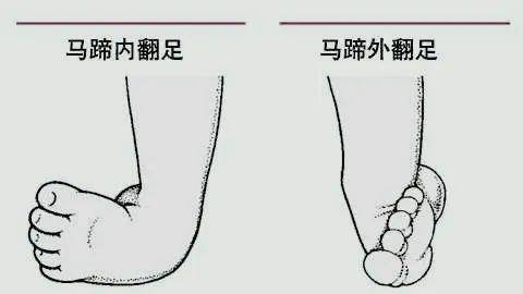 包括:拇外翻,平足症,高弓足,马蹄内翻足,马蹄高弓足,摇椅足,踝内翻,踝