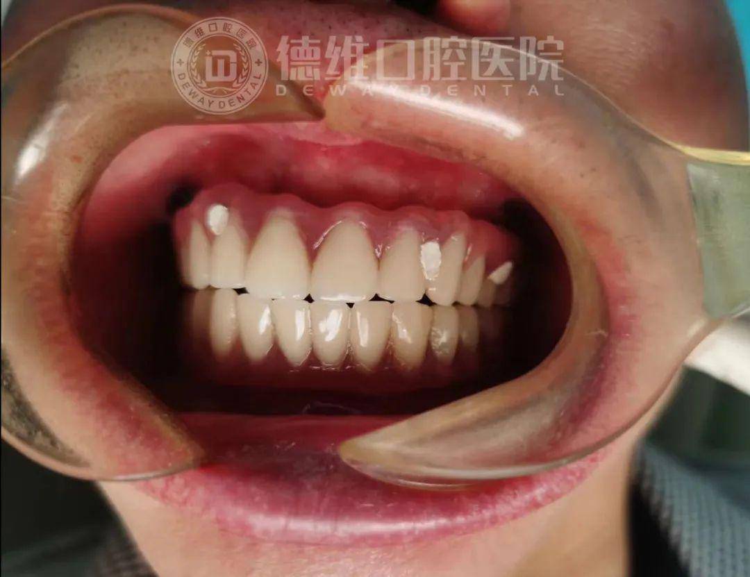 【种牙案例】全口种植牙,摆脱数年缺牙烦恼