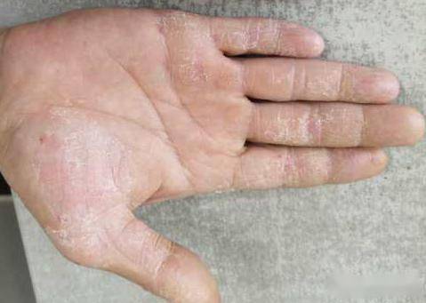 水疱形成,手掌指腹干燥脱皮,掌心,指背可有肥厚性斑块;湿疹急性期可见