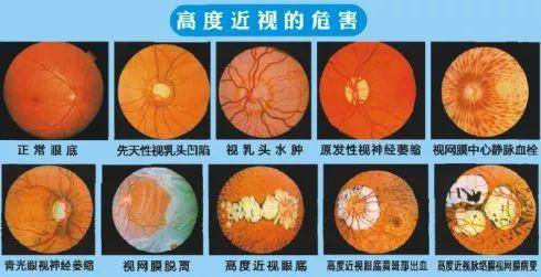 【护眼tips】高度近视的危害,你知道吗?